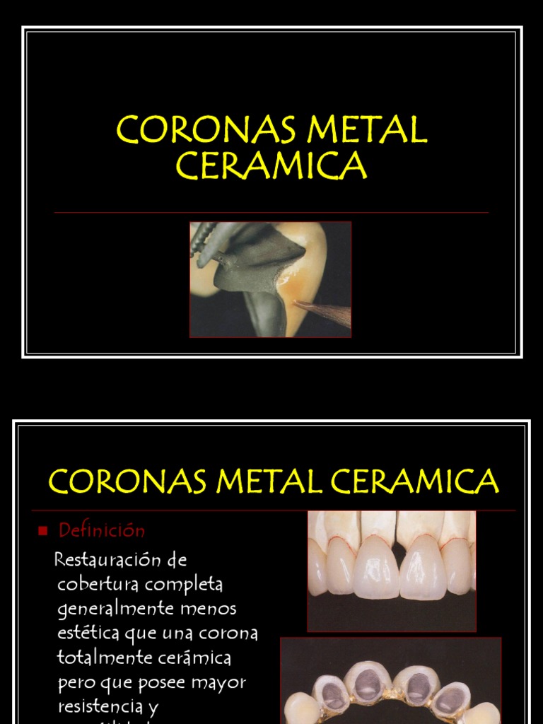 Coronas Metal Ceramica | PDF | Aleación | Platino
