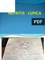 Nefritis Lupica