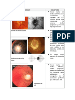 Características Clínicas No, DX Diferenciales Excavaciones Glaucomatosas