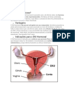 DIU hormonal reduz fluxo e previne gravidez de forma eficaz