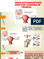 Métodos Anticonceptivos Definitivos Ligadura de Trompas PDF