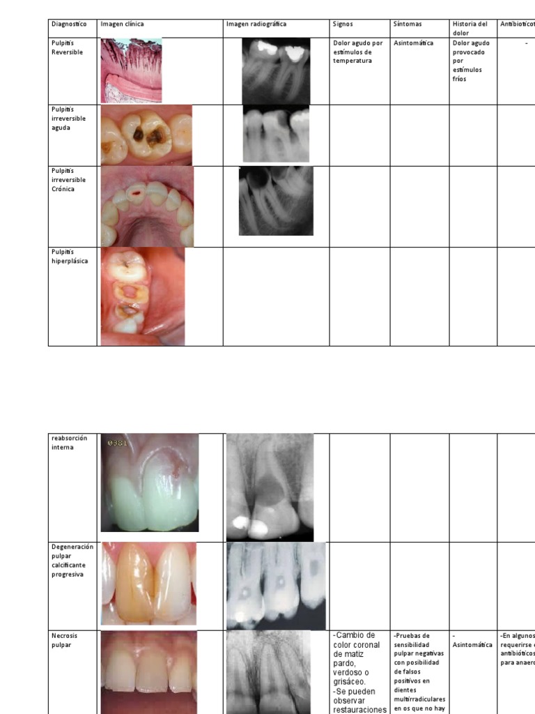 Pulpitis Reversible PDF