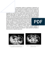 CASO CLÍNICO Cancer Riñon PDF