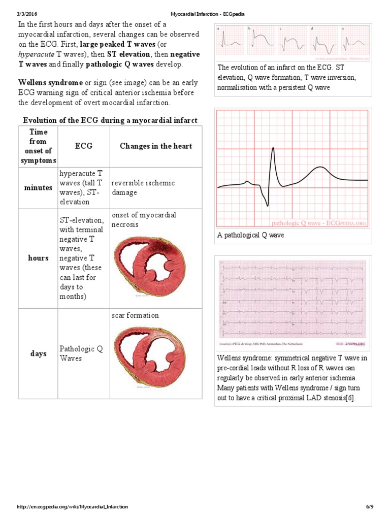 Evolution of The ECG During A Myocardial Infarct PDF | PDF