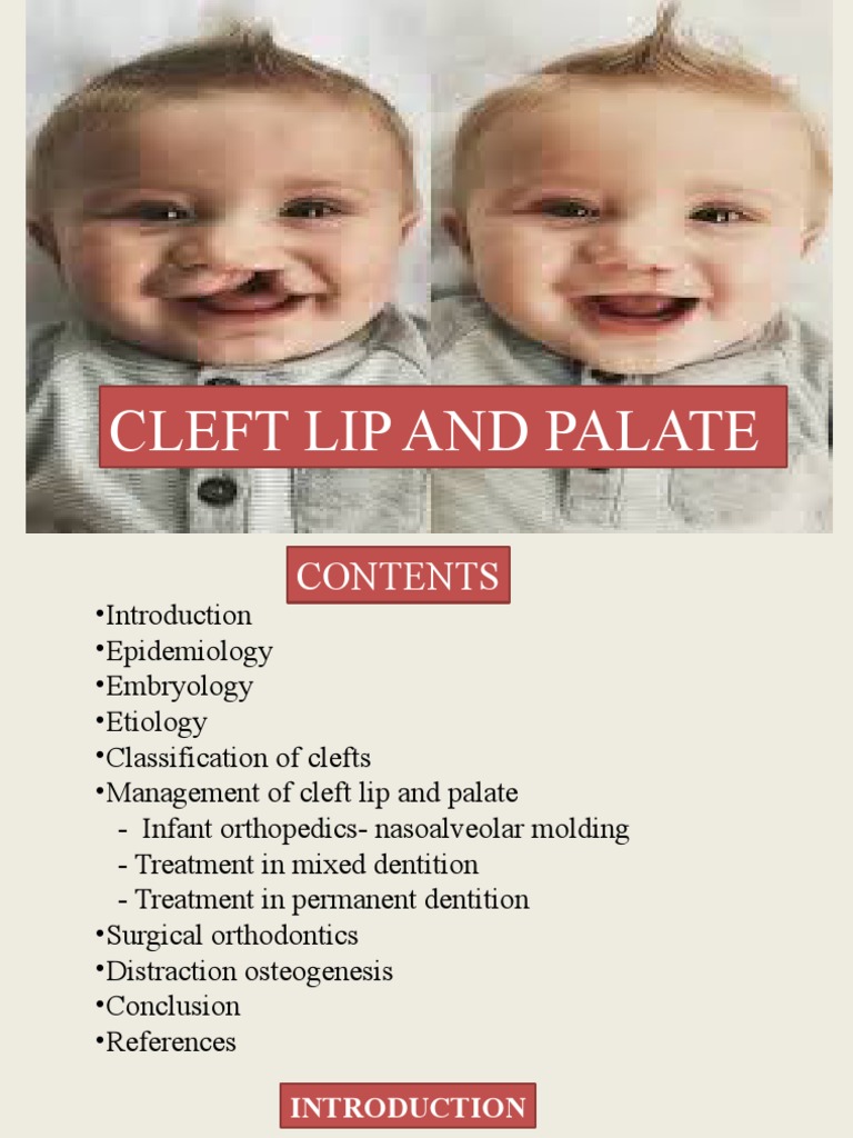 Cleft Lip and Palate PDF Orthodontics Face