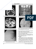 Rhinoorbital Mucormycosis