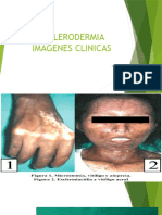 Esclerodermia: imágenes clínicas