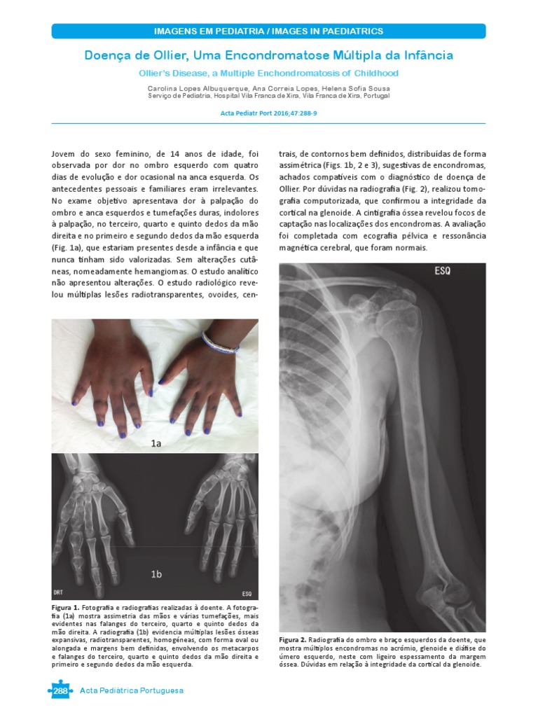 Sd. de Ollier | PDF | Neoplasmas | Medicina Clínica