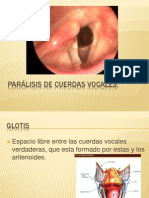 Paralisis de Cuerdas Vocales