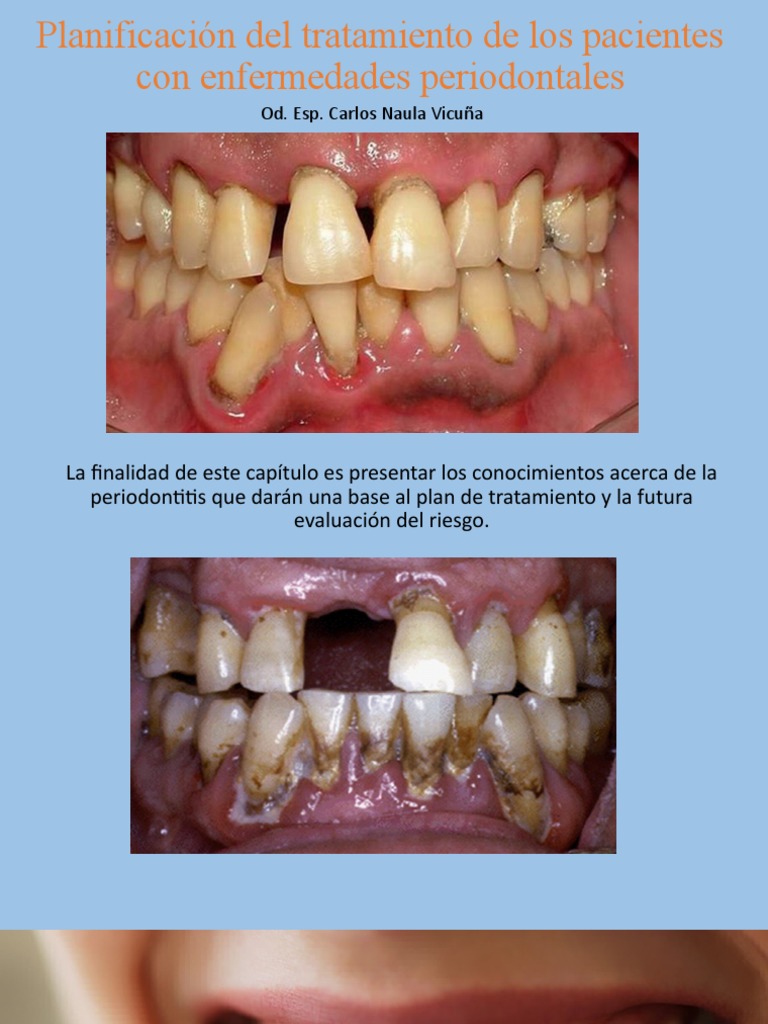 Tratamiento Periodontal | PDF | Odontología | Epidemiología