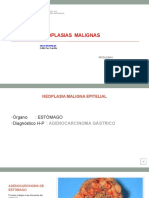 Clase Grabada Practica 09 Neoplasias 3 (Neoplasias Malignas)