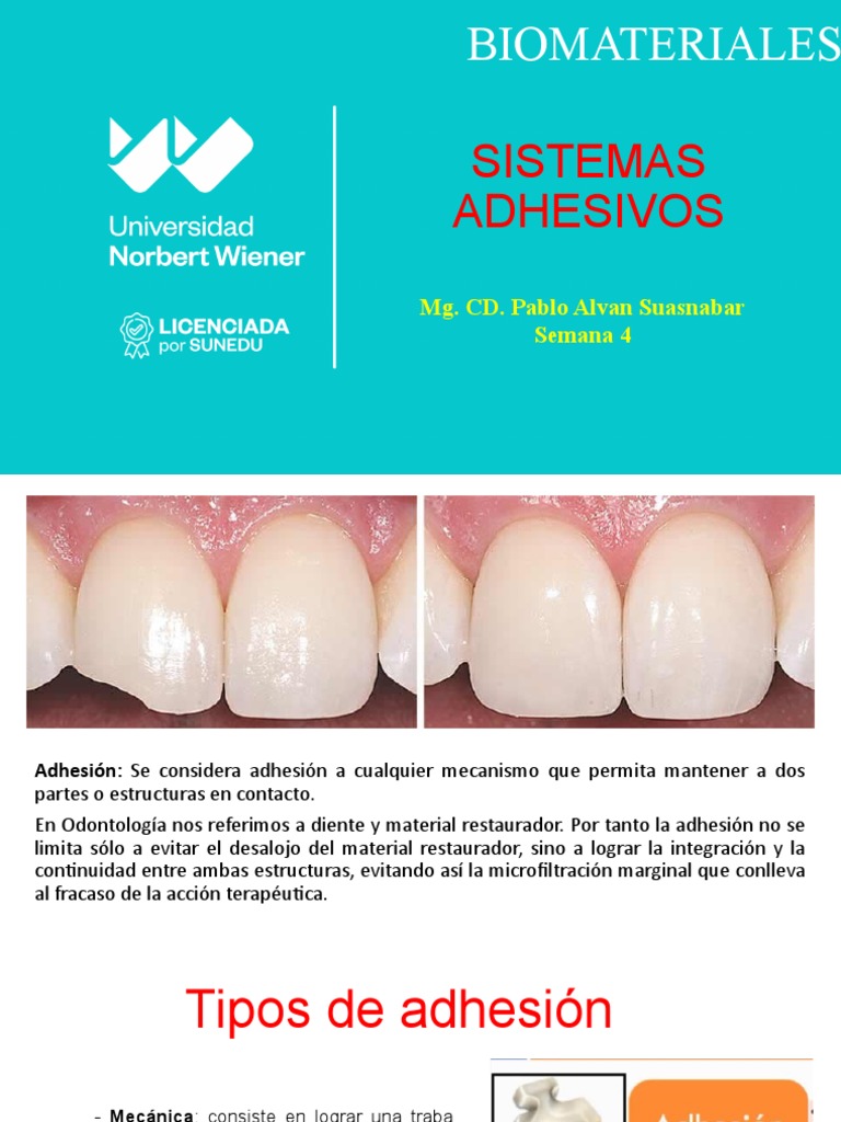 Clasificación de Sistemas Adhesivos Dentales | PDF | Esmalte de dientes ...