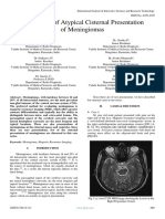 Case Series of Atypical Cisternal Presentation of Meningiomas