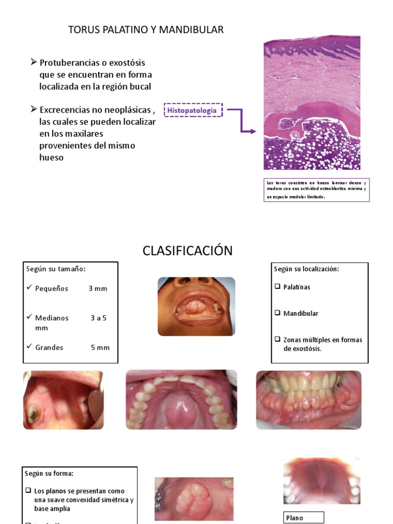 Torus Palatino y Mandibular | PDF | Hueso | Enfermedades y trastornos