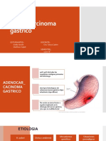 Adenocarcinoma