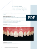 Consideraciones Periodontales para Restauraciones Ceramicas Adheridas - En.es