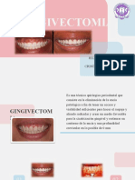 Gingivectomia 1