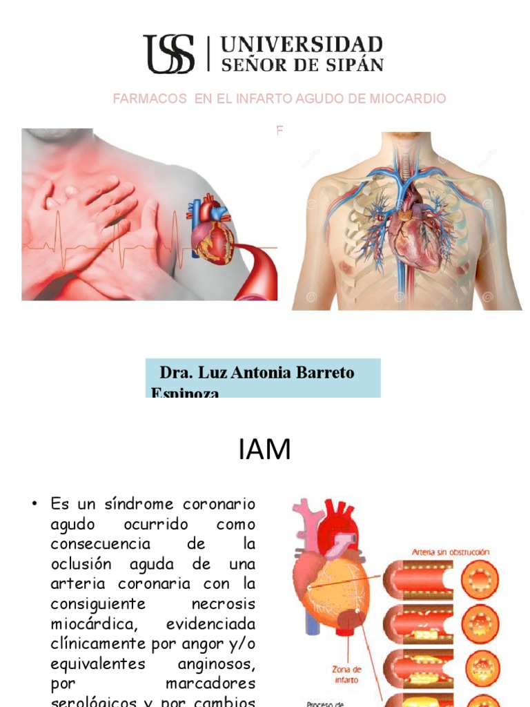 Infarto Agudo de Miocardio | Descargar gratis PDF | Infarto de ...
