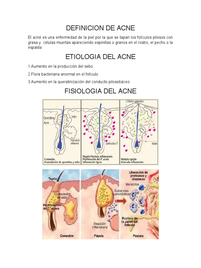 Definición y fisiopatología del acné | PDF | Piel | Sistema endocrino
