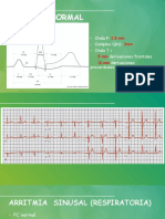 Flashcards EKG