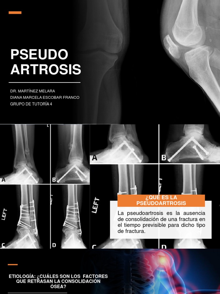 PSEUDOARTROSIS | PDF