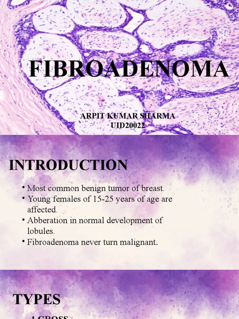 Understanding Fibroadenoma in Breasts | PDF