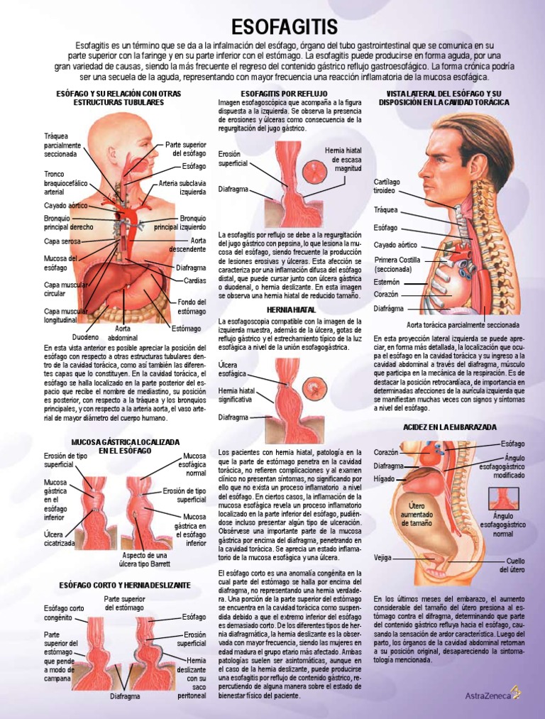 Esofagitis | PDF