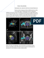 Cáncer de Próstata Mod.9