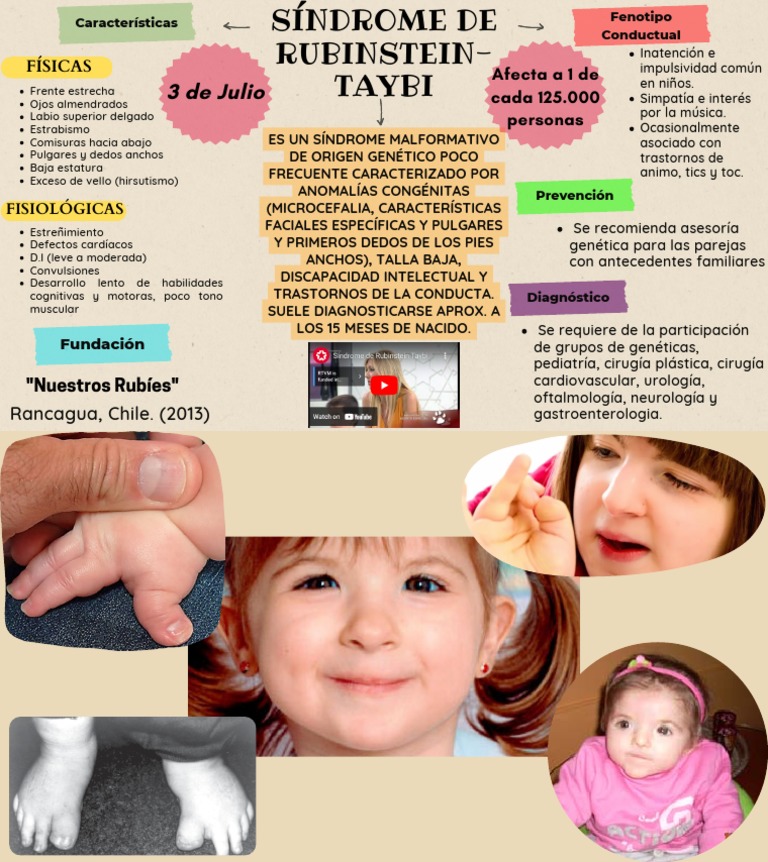 SÍNDROME DE RUBINSTEIN-TAYBI - CANAL INFANTIL