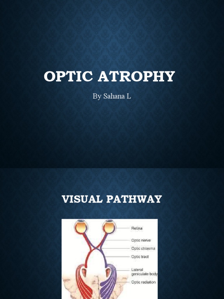 Optic Atrophy | PDF