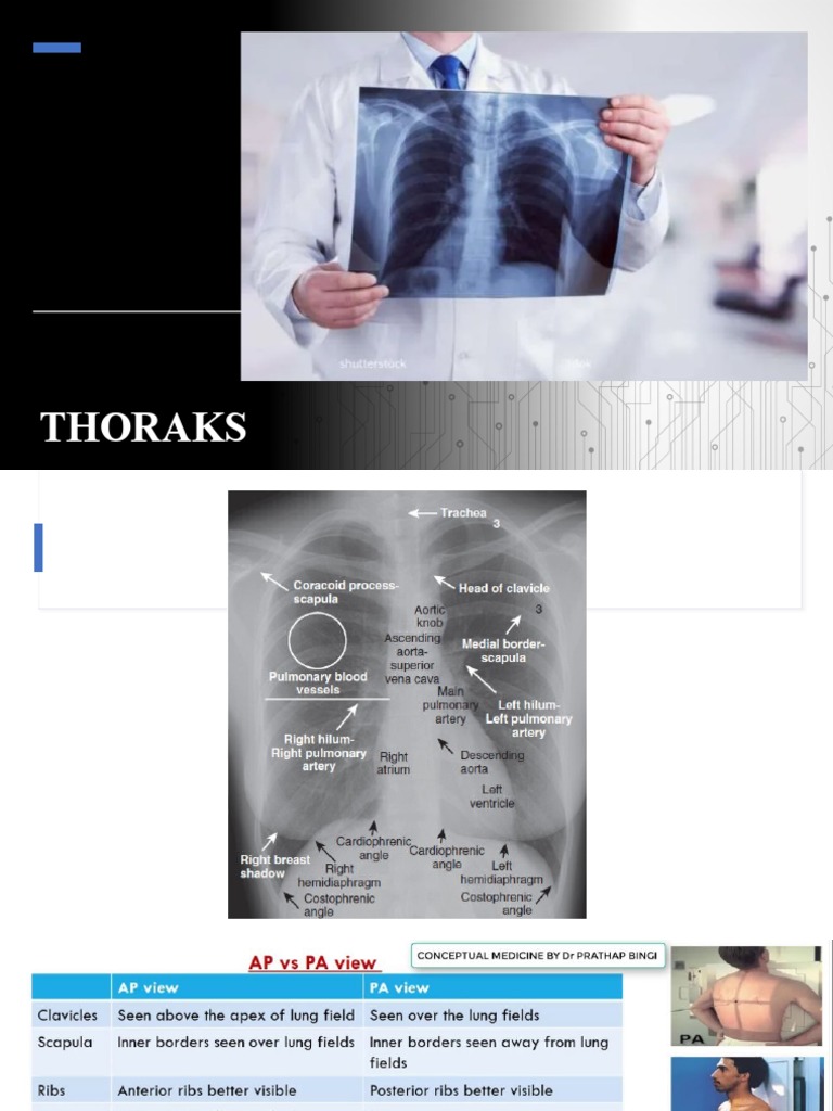 Thorak S | PDF | Aorta | Lung