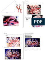 Hematomas Intracerebral