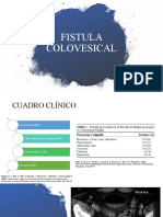 Fistula Colovesical