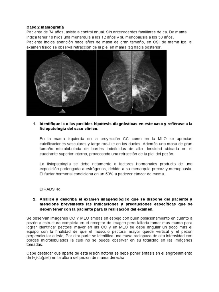 Mamografía: Evaluación de Masa en Mama Izquierda | PDF | Cáncer de mama ...