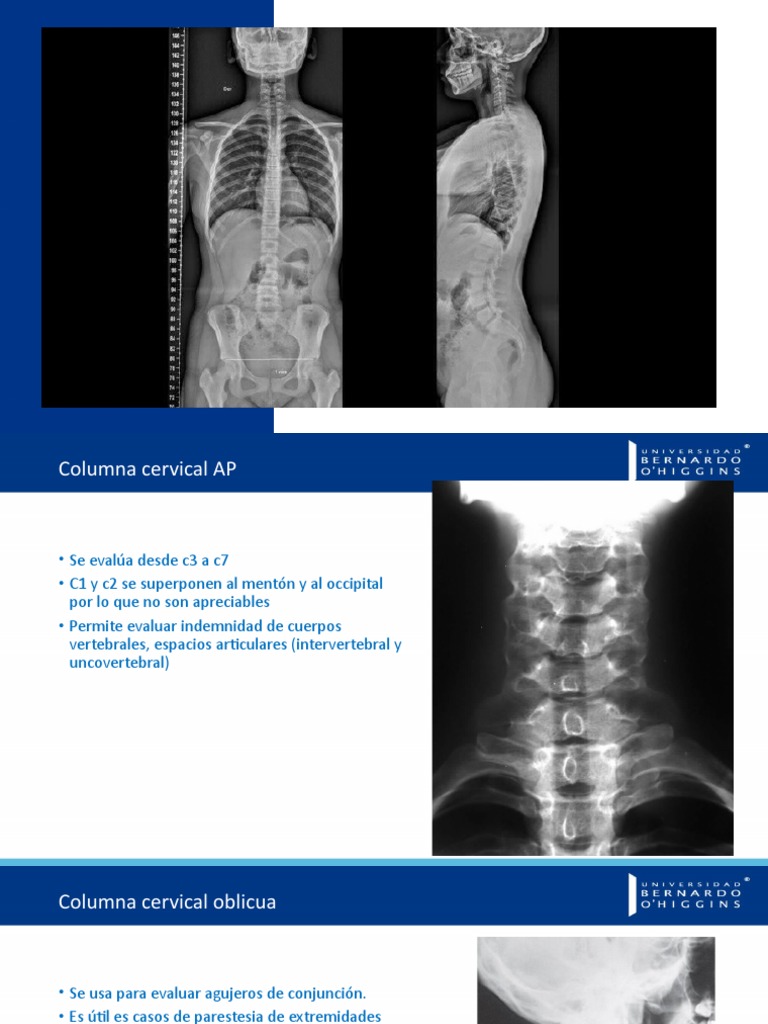 Radiología de la Columna Vertebral | PDF | La columna vertebral | Vértebra
