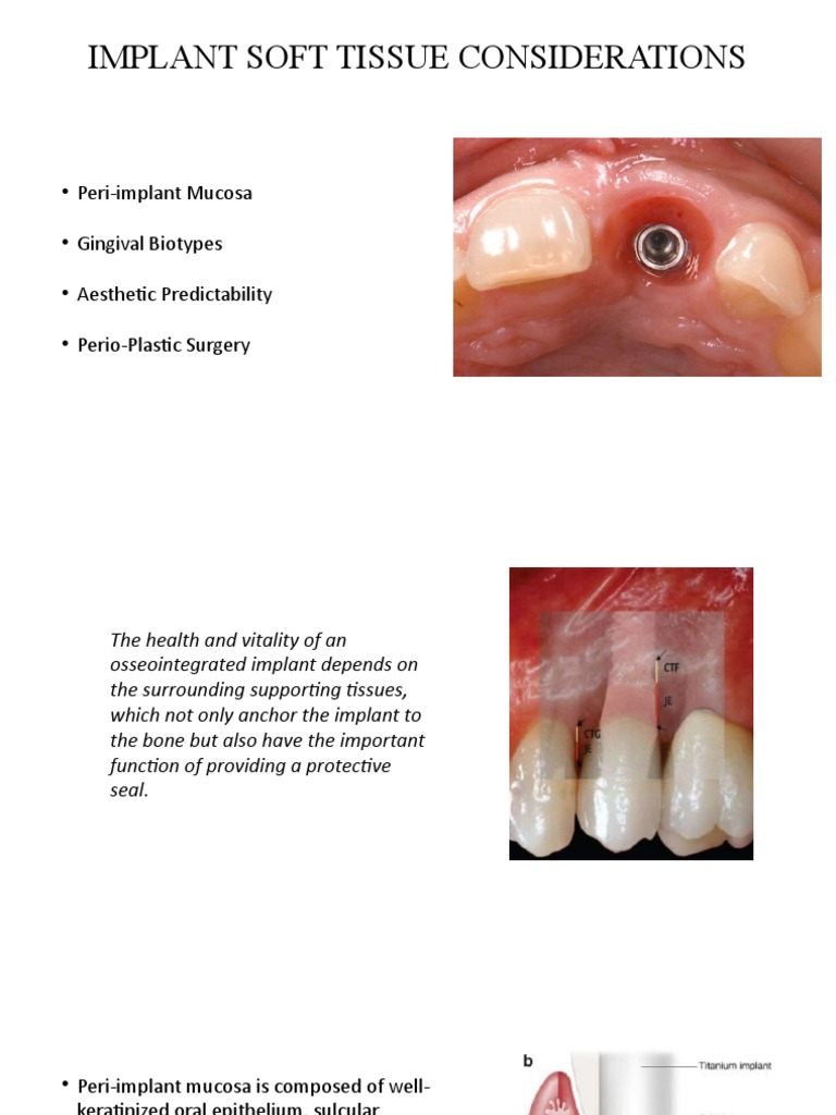 Soft Tissue Considerations in Implants | PDF | Dental Implant ...