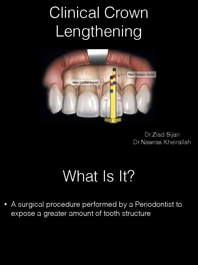 Clinical Crown Lengthening PDF