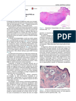 Melanoma Intradermico