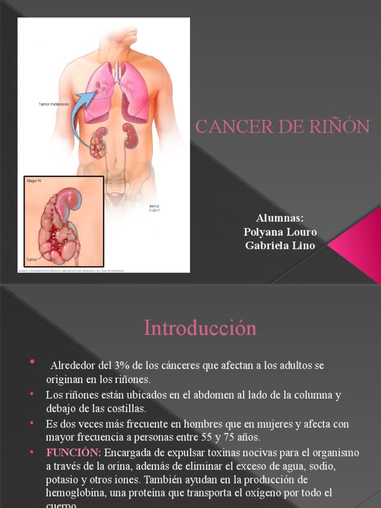 Cancer de Riñon (1) | PDF | Cáncer | Riñón
