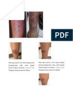 Anamnesis Dermatitis Numularis