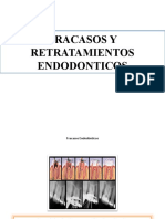 Fracasos y Retratamientos Endodonticos