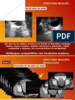 presentacin_11.casos_de_teratoma_maduro.