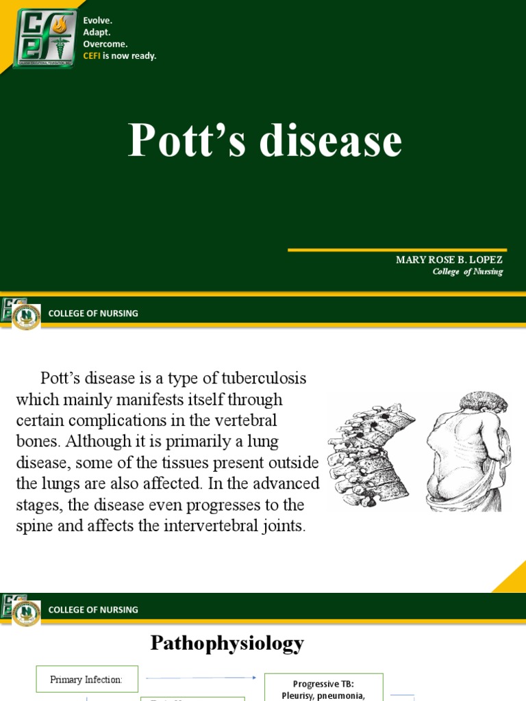 Understanding Pott's Disease: Symptoms & Treatment | PDF