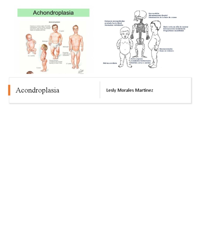 Acondroplasia PDF