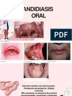 Candidiasis Bucal