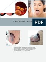 Cancer de Lengua