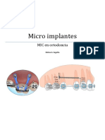 Apunde de Microimplantes