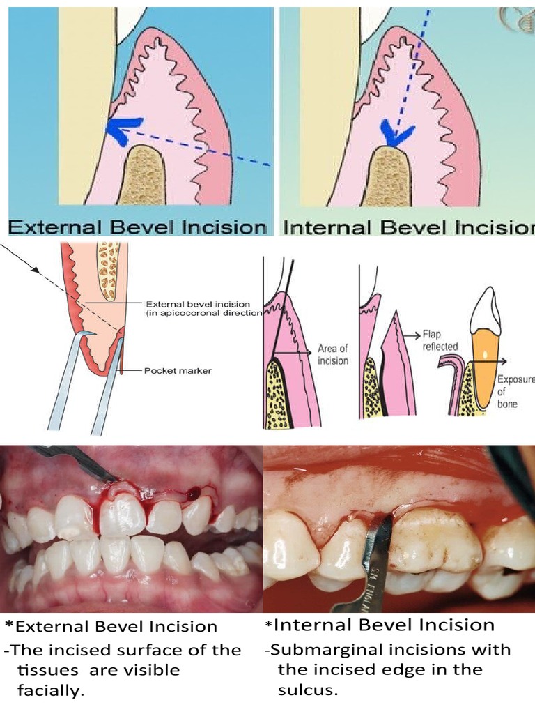 Internal vs External Bevel Incisions | PDF