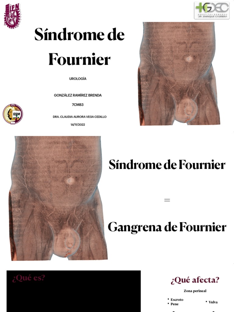 7CM83síndrome de FournierGRB PDF Epidemiología Causas de la muerte