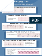 Ekg Patologico